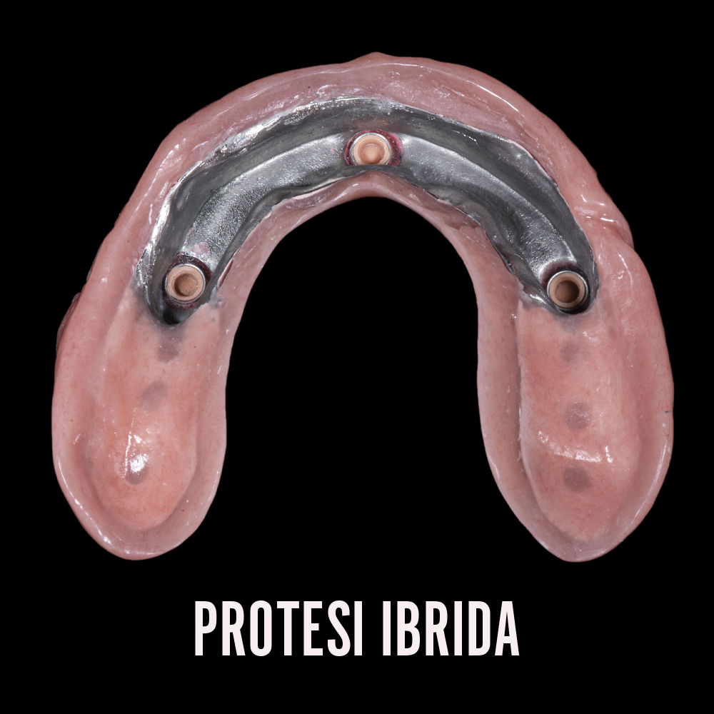 Protesi ibrida