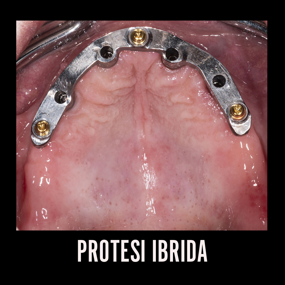 PROTESI IBRIDA_B